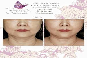 Tarik Benang (Threadlift)